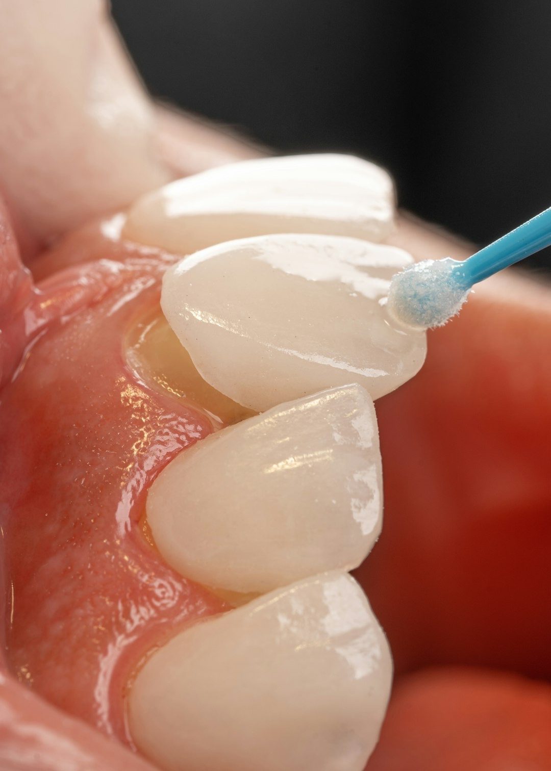 Close-up of a hand-crafted porcelain veneer being bonded to a front tooth
