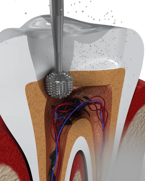 Cross-section of a tooth showing a dental burr drilling an access cavity into the pulp chamber to reach the infected nerves and blood vessels
