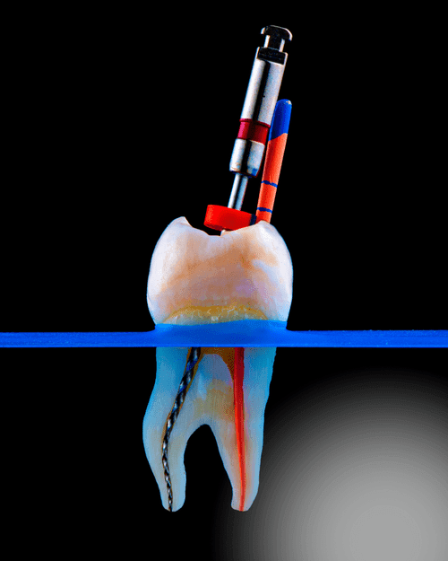 Cross-section illustration of a tooth during root canal treatment — endodontic files cleaning the canals